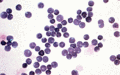Cerebrospinal fluid of an ALL patient