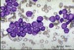 Image of cells from an L1 case of ALL