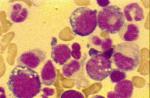 Image of cells from an L3 case of ALL