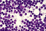 Image of ALL bone marrow aspirate
