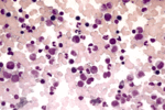 Image of normal bone marrow aspirate