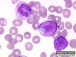 Normal blood with two lymphoblasts and a neutrophil